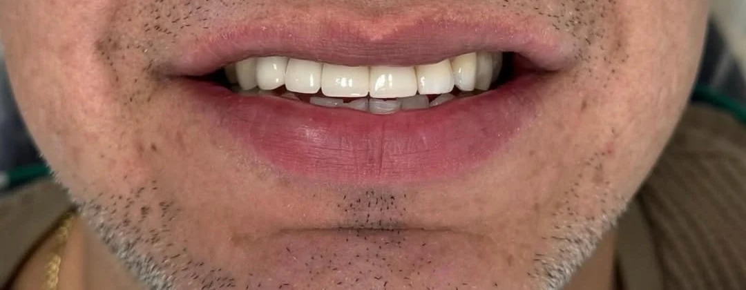 The same patient after treatment: the gap is closed and the front teeth are even