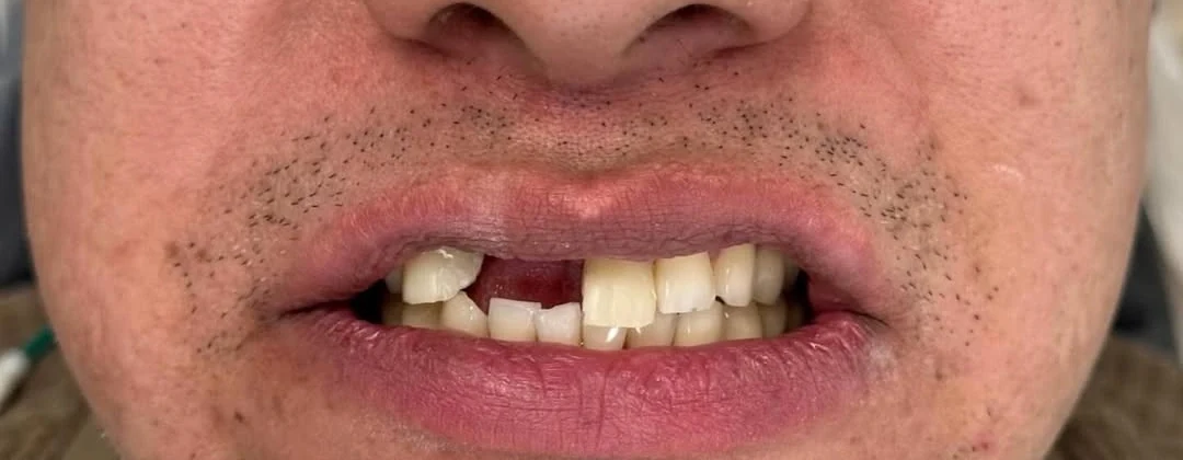 A patient of Iconic Smiles before treatment: two upper front teeth are missing