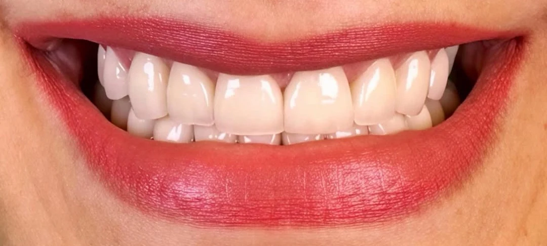 The same patient after treatment: an even, brighter upper arch