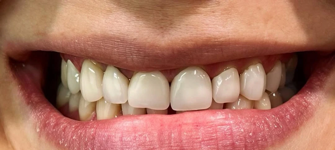 A patient of Iconic Smiles before treatment: the upper teeth are uneven and discoloured