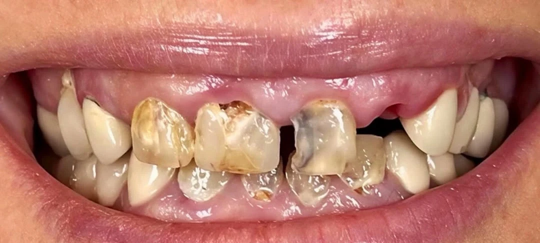 A patient of Iconic Smiles before full-arch treatment: several upper teeth are broken, decayed or missing